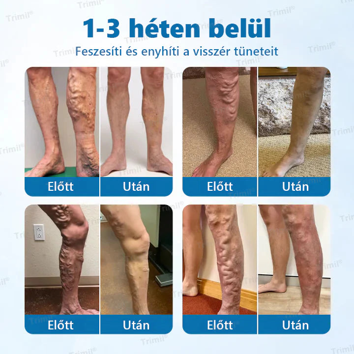 💙💙Spray de ervas Trimil® VeinGuard - ✅ Clinicamente comprovado que elimina varizes em apenas 7 dias!