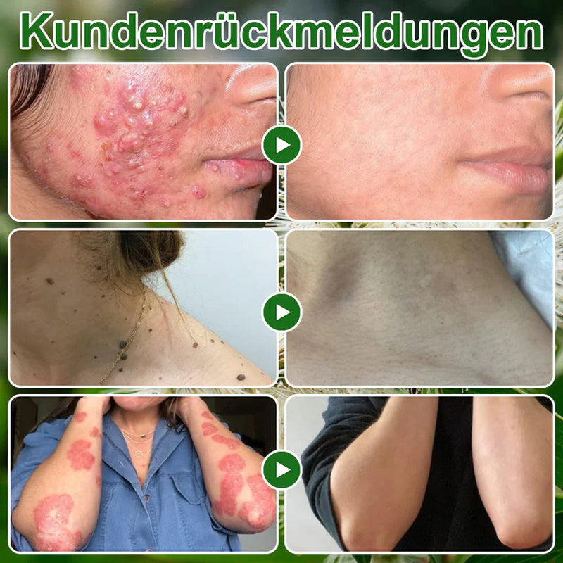 Teebaumol Creme – Remove imperfeições da pele, repara pele danificada, ilumina e neutraliza o envelhecimento