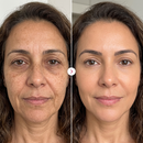 LumiLift® Creme ultralaser