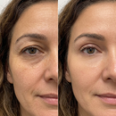 LumiLift® Creme ultralaser